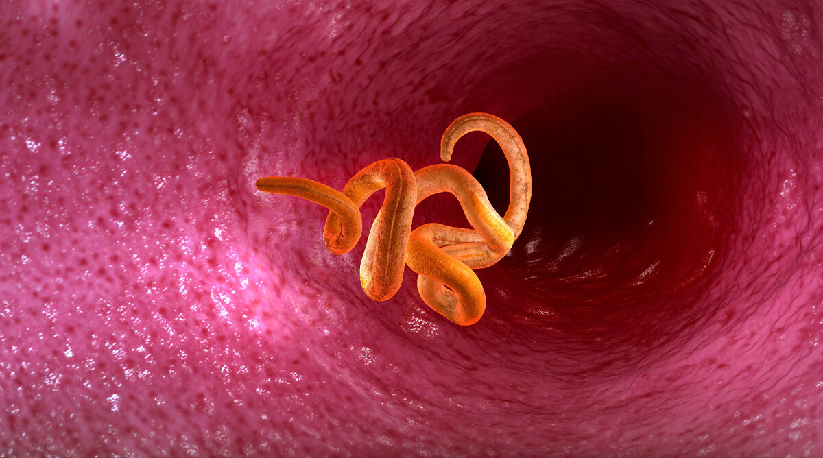 Strongyloidiasis stercoralis