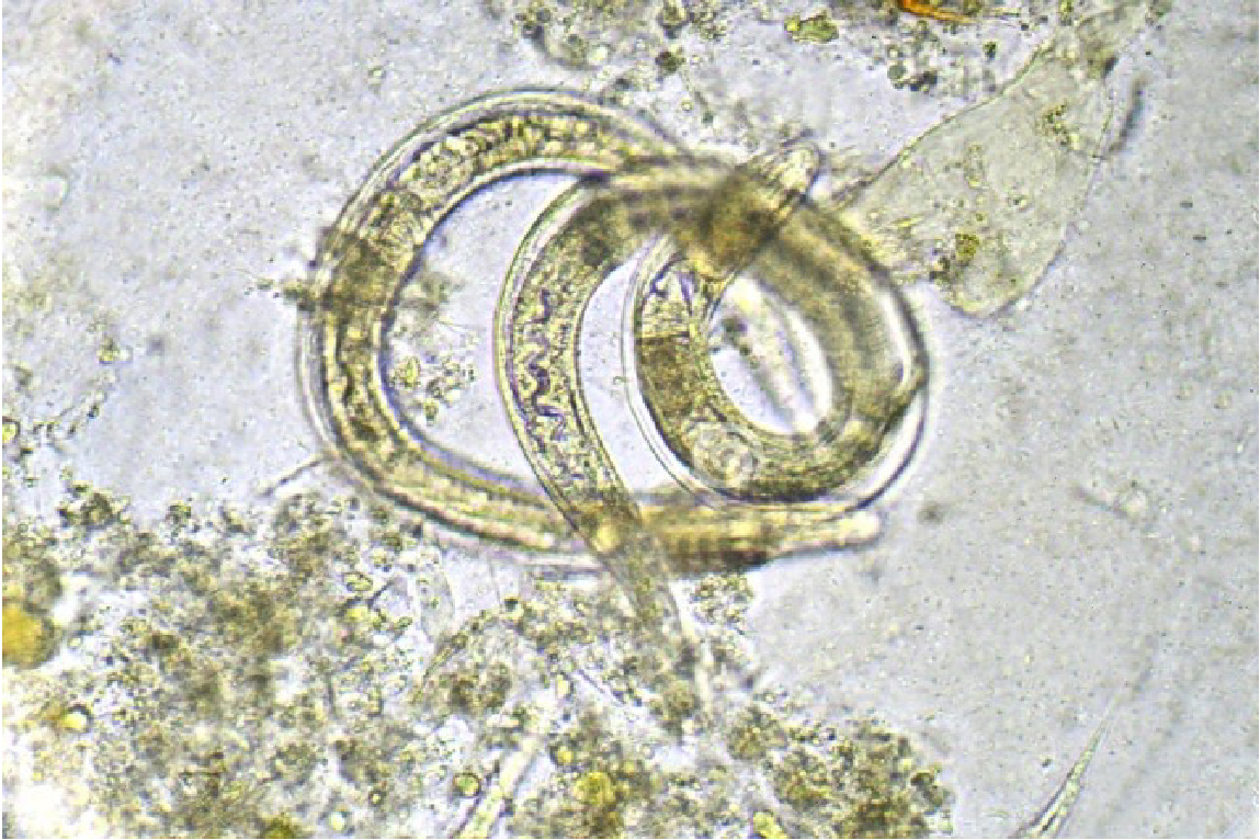 ©WHO / Strongyloides stercoralis threadworm in stool, analyzed by microscope